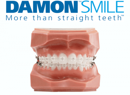 Damon Systeme Maroc Centre Orthodontie Bichra Marrakech 01